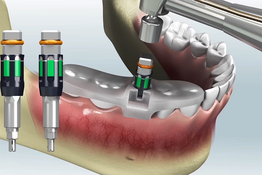 روش‌های مختلف دندانپزشکی دیجیتال چیست؟